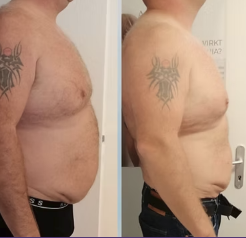 Vorher-Nachher-Vergleich Bauch seitlich