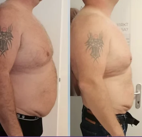 Vorher-Nachher-Vergleich Bauch seitlich